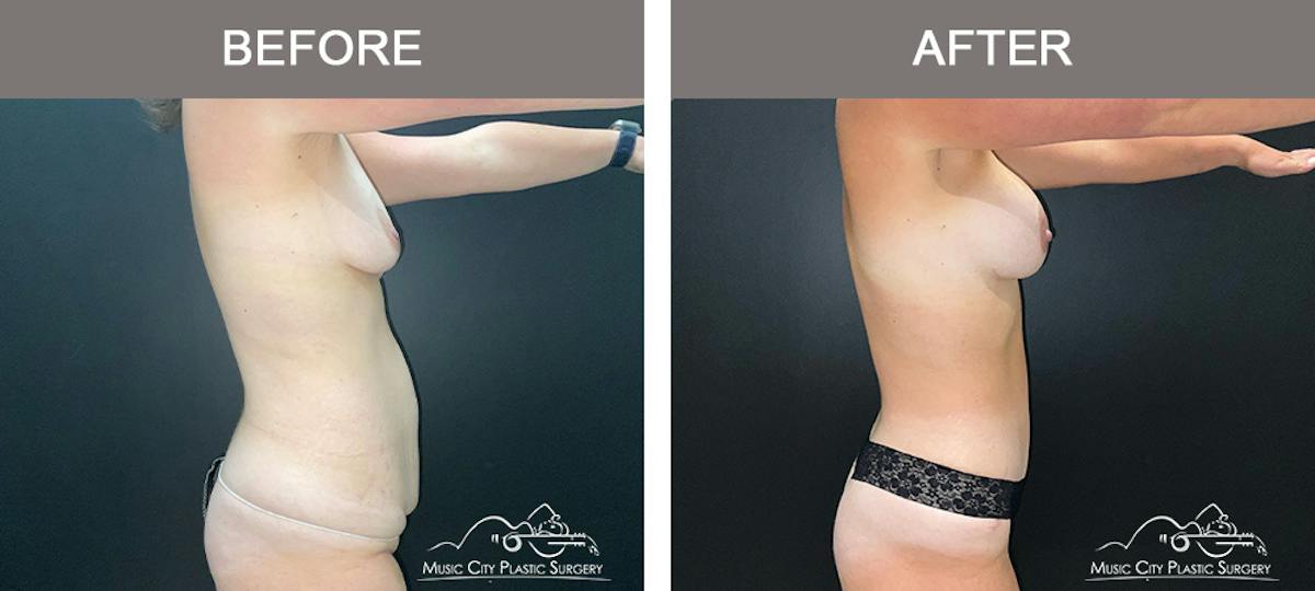Tummy Tuck (Abdominoplasty) Before & After Gallery - Patient 915712 - Image 4