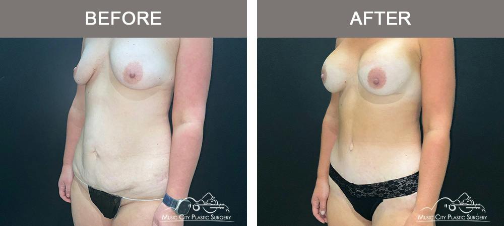 Tummy Tuck (Abdominoplasty) Before & After Gallery - Patient 915712 - Image 5