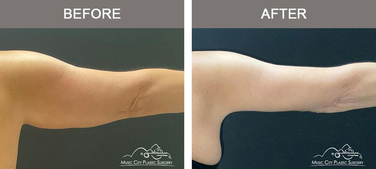 Arm Lift Before & After Gallery - Patient 121145 - Image 5