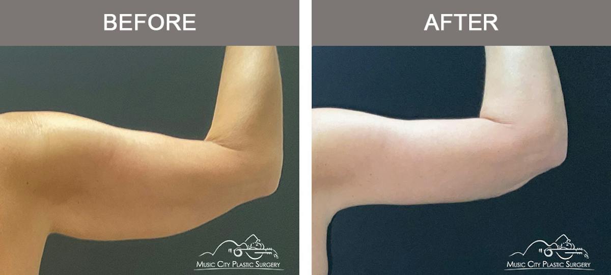 Arm Lift Before & After Gallery - Patient 121145 - Image 7