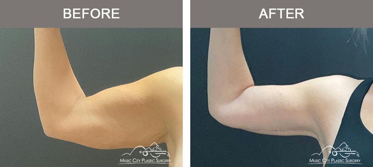 Arm Lift Before & After Gallery - Patient 121145 - Image 4