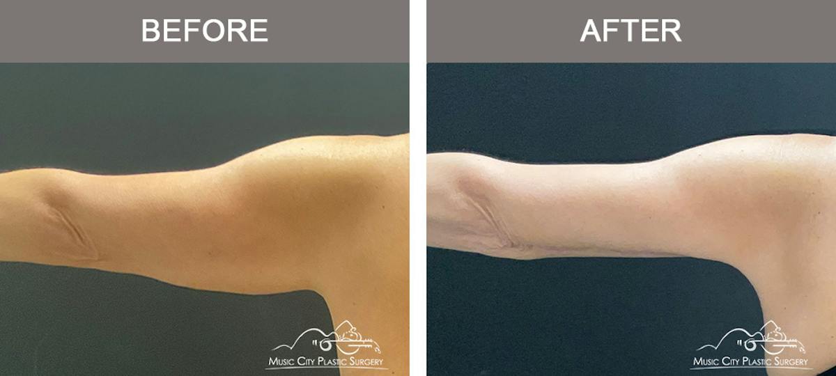 Arm Lift Before & After Gallery - Patient 121145 - Image 2
