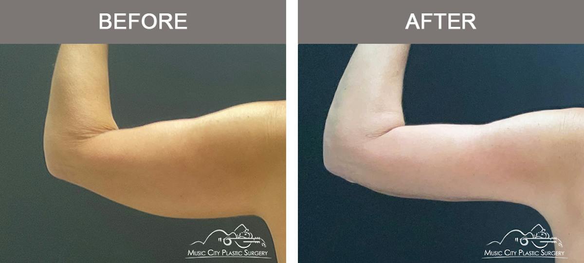 Arm Lift Before & After Gallery - Patient 121145 - Image 3