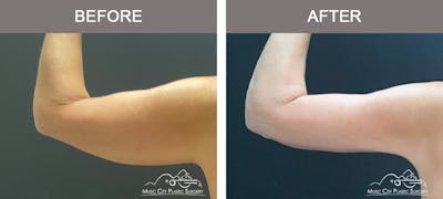 Arm Lift Before & After Gallery - Patient 121145 - Image 3