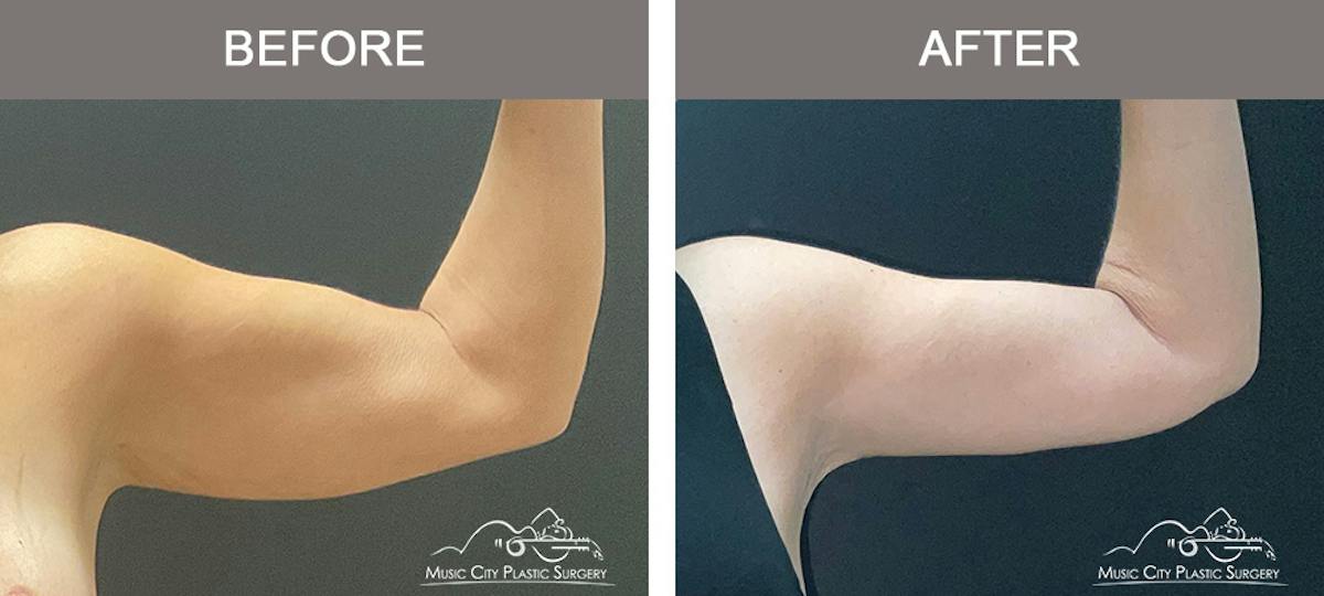 Arm Lift Before & After Gallery - Patient 121145 - Image 8