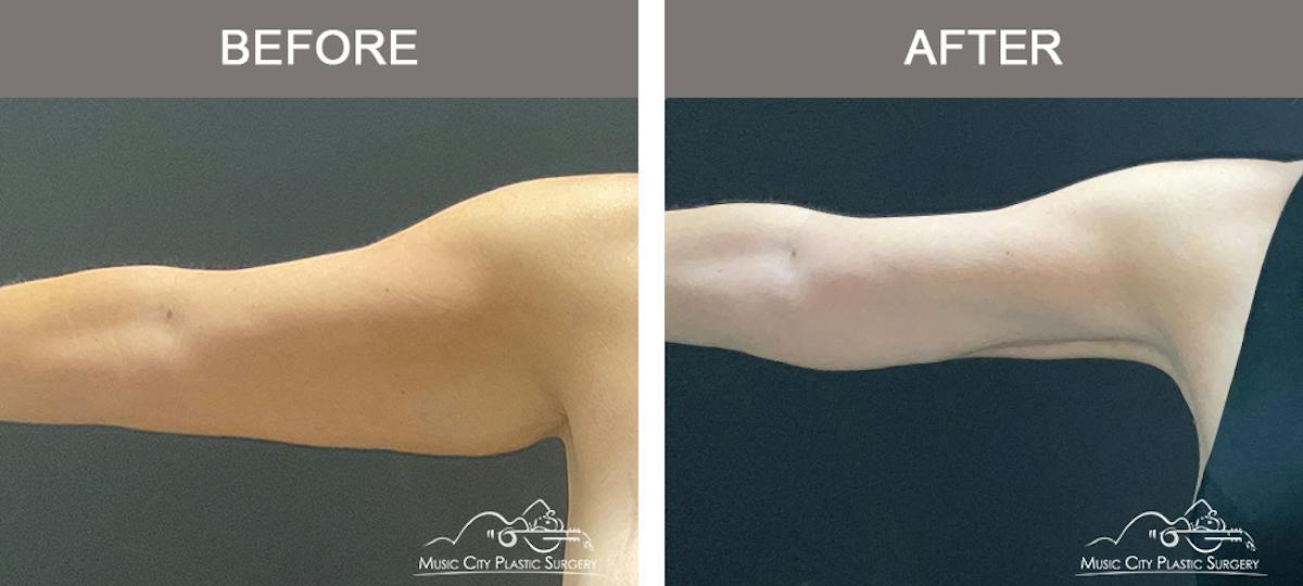 Arm Lift Before & After Gallery - Patient 121145 - Image 1