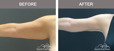Arm Lift Before & After Gallery - Patient 121145 - Image 1