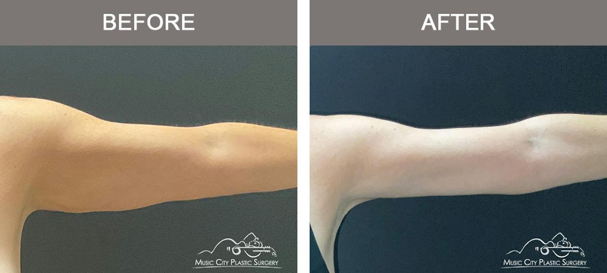 Arm Lift Before & After Gallery - Patient 121145 - Image 6