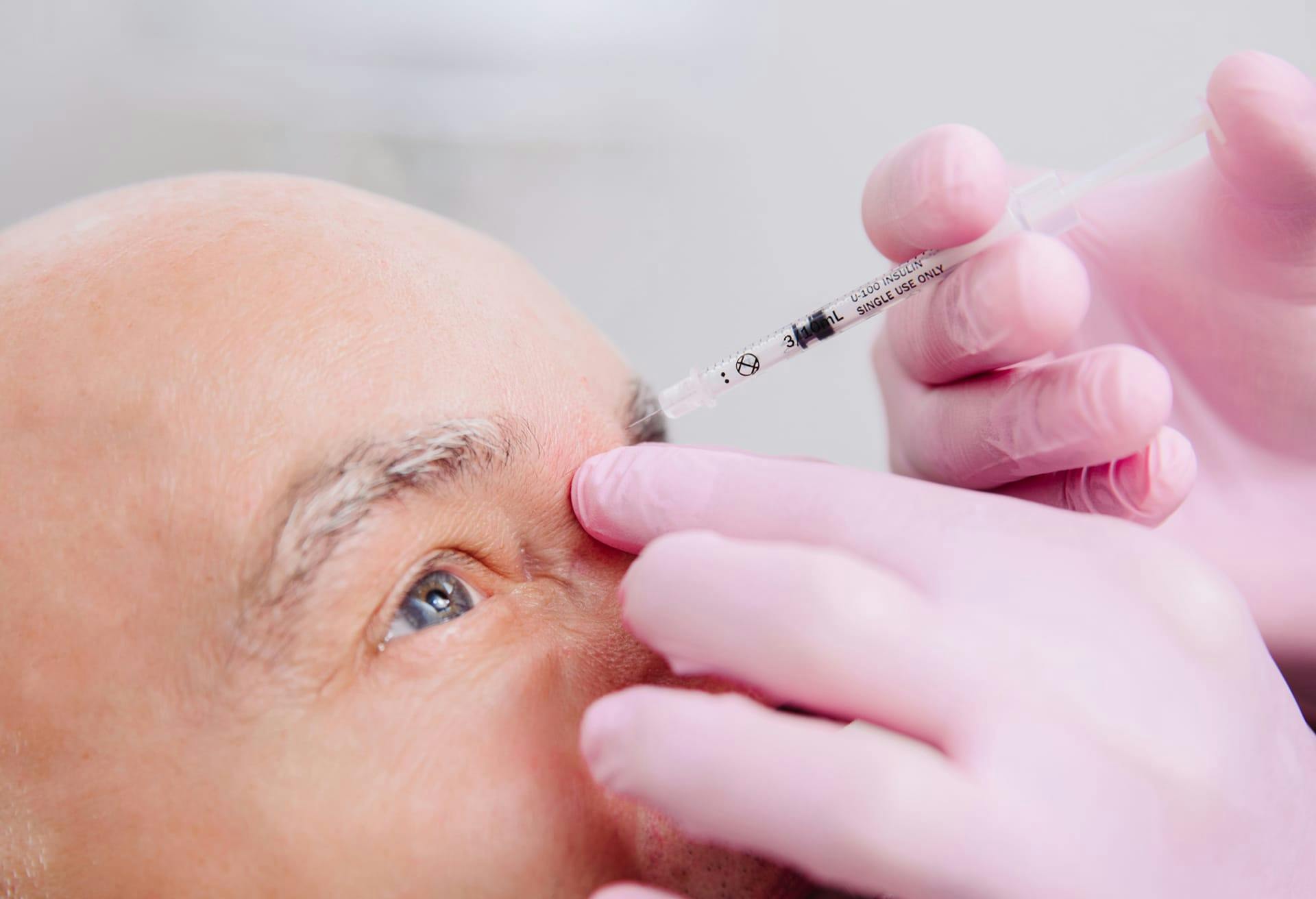 man getting fillers in the eyebrow area