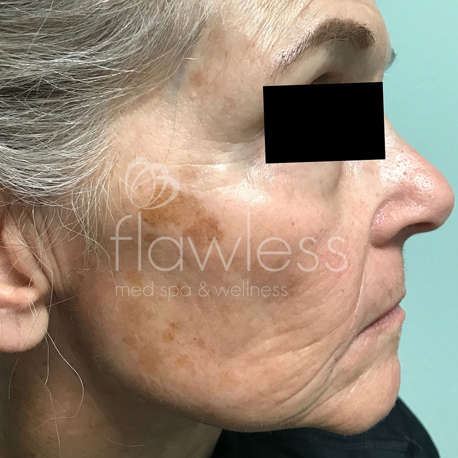 Age Spots Before & After Gallery - Patient 58193336 - Image 1