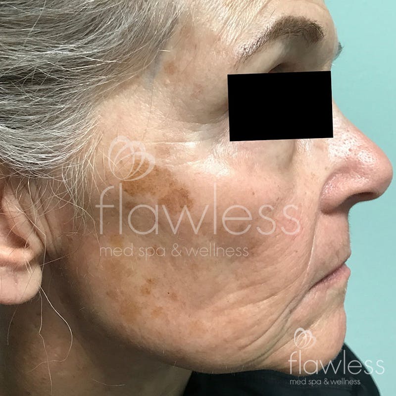 Age Spots Before & After Gallery - Patient 58193336 - Image 1