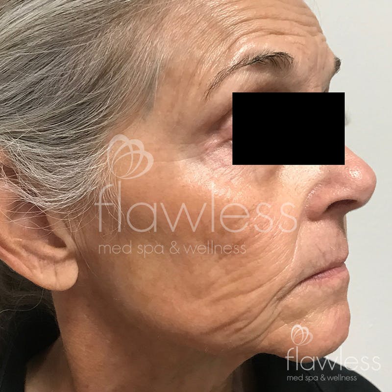 Age Spots Before & After Gallery - Patient 58193336 - Image 2