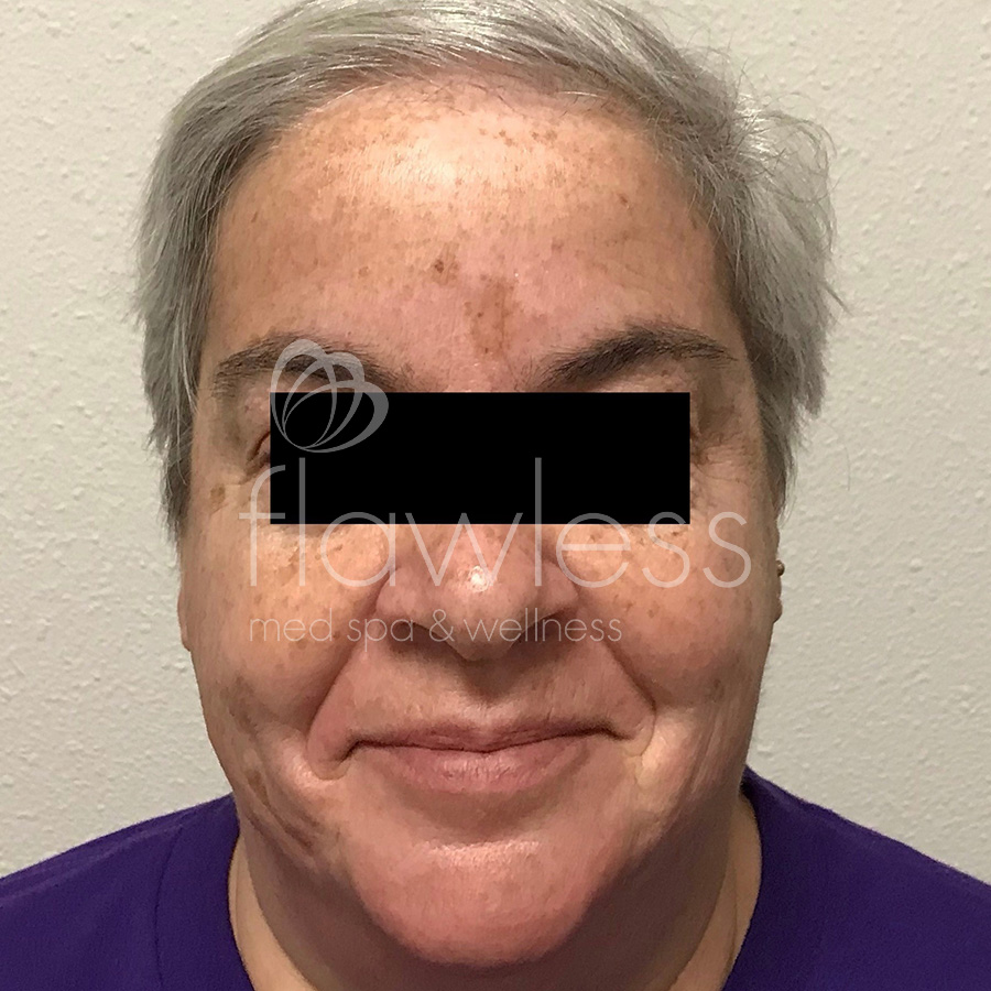 Age Spots Before & After Gallery - Patient 58193337 - Image 1