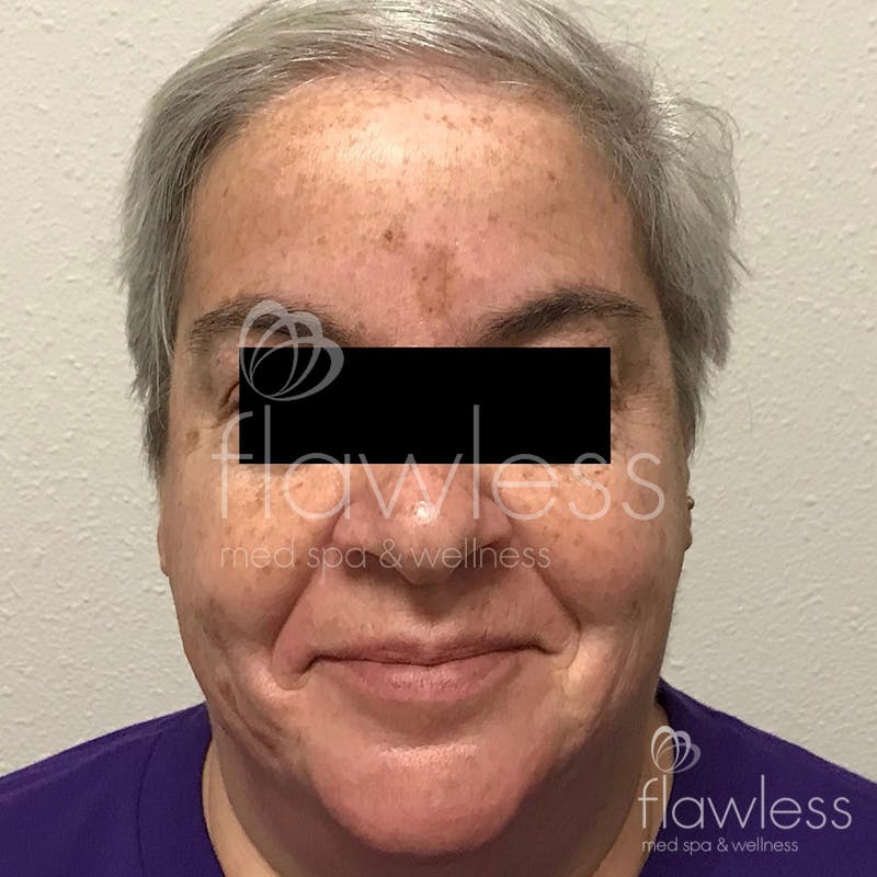 Age Spots Before & After Gallery - Patient 58193337 - Image 1