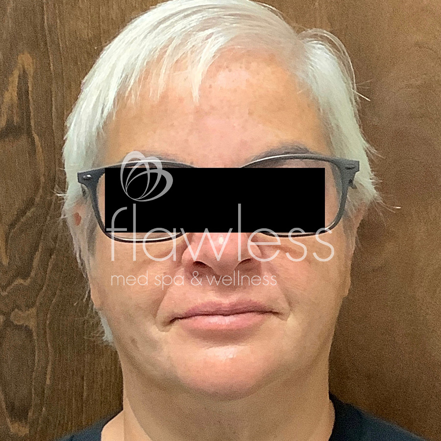 Age Spots Before & After Gallery - Patient 58193337 - Image 2