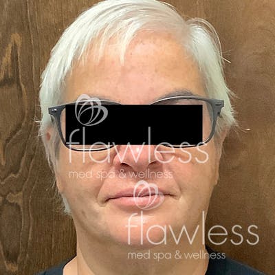 Age Spots Before & After Gallery - Patient 58193337 - Image 2