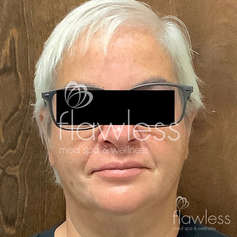 Age Spots Before & After Gallery - Patient 58193337 - Image 2