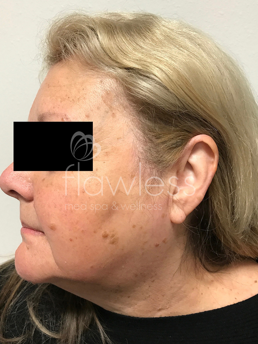 Age Spots Before & After Gallery - Patient 58193340 - Image 1