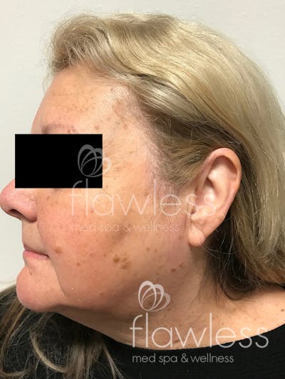 Age Spots Before & After Gallery - Patient 58193340 - Image 1
