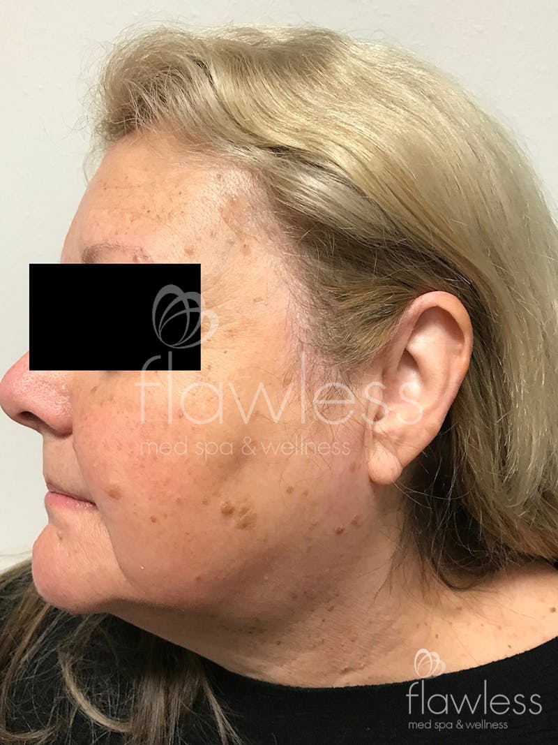 Age Spots Before & After Gallery - Patient 58193340 - Image 1