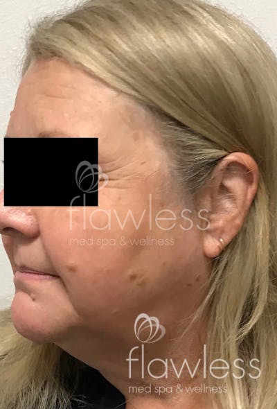 Age Spots Before & After Gallery - Patient 58193340 - Image 2