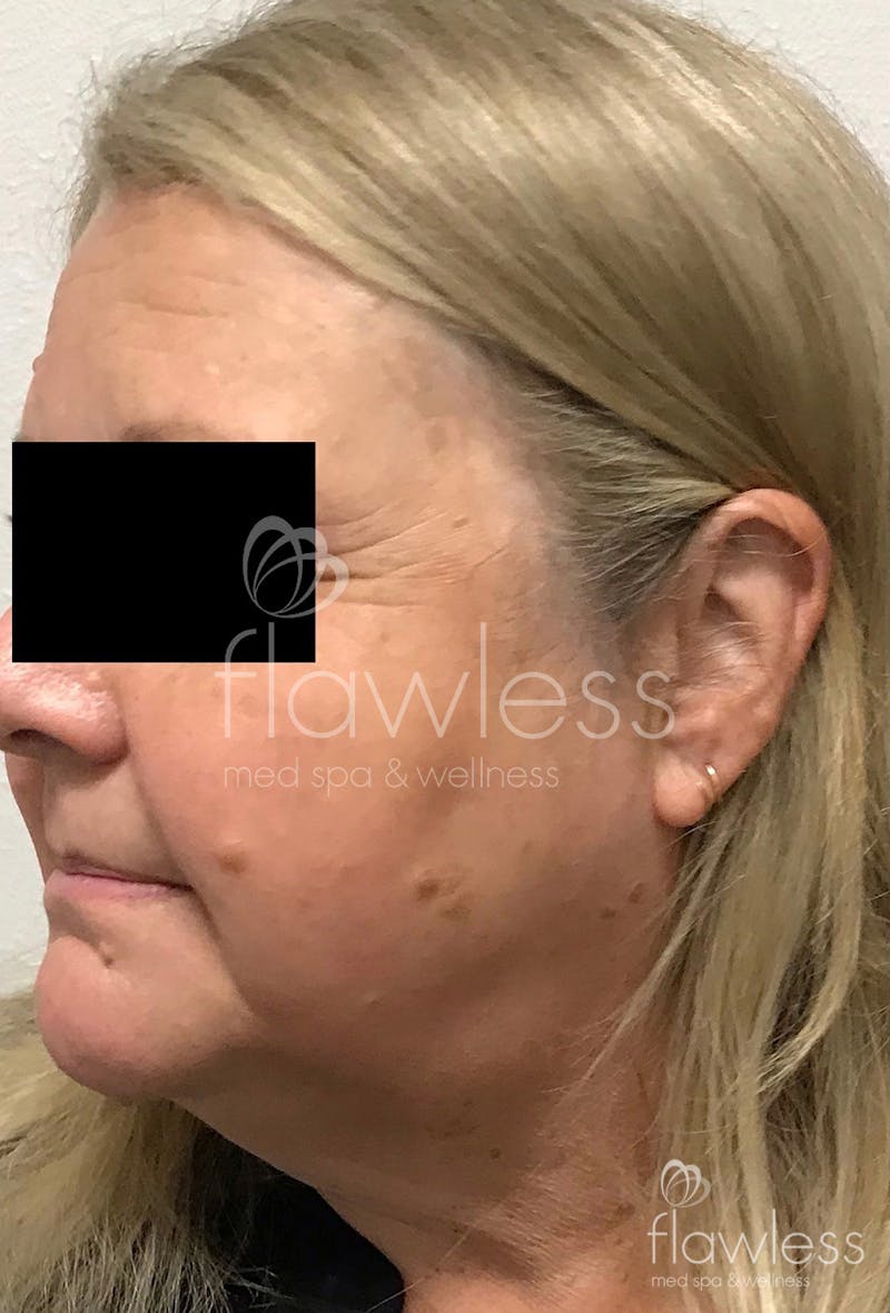 Age Spots Before & After Gallery - Patient 58193340 - Image 2