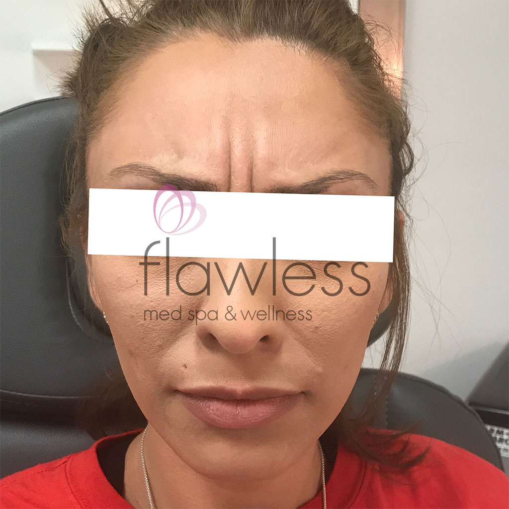 BOTOX Before & After Gallery - Patient 58193344 - Image 1
