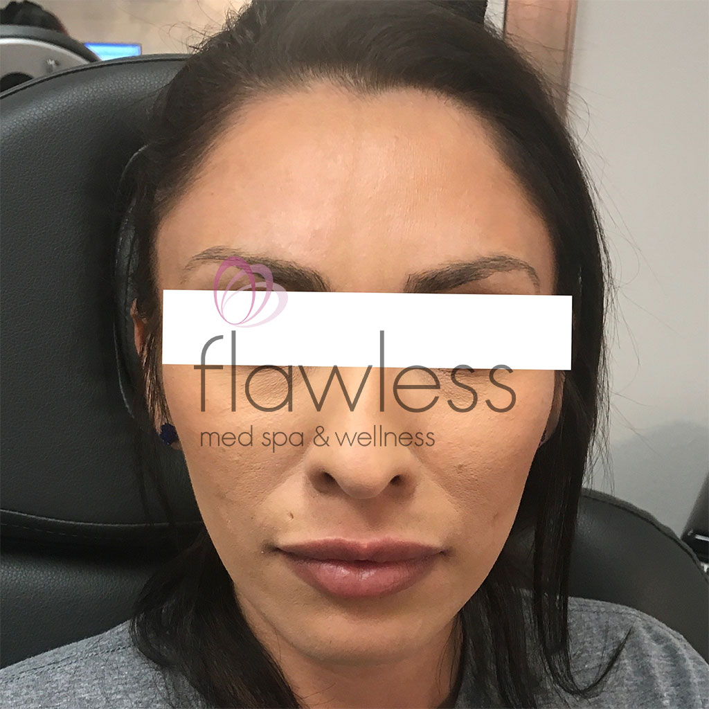 BOTOX Before & After Gallery - Patient 58193344 - Image 2