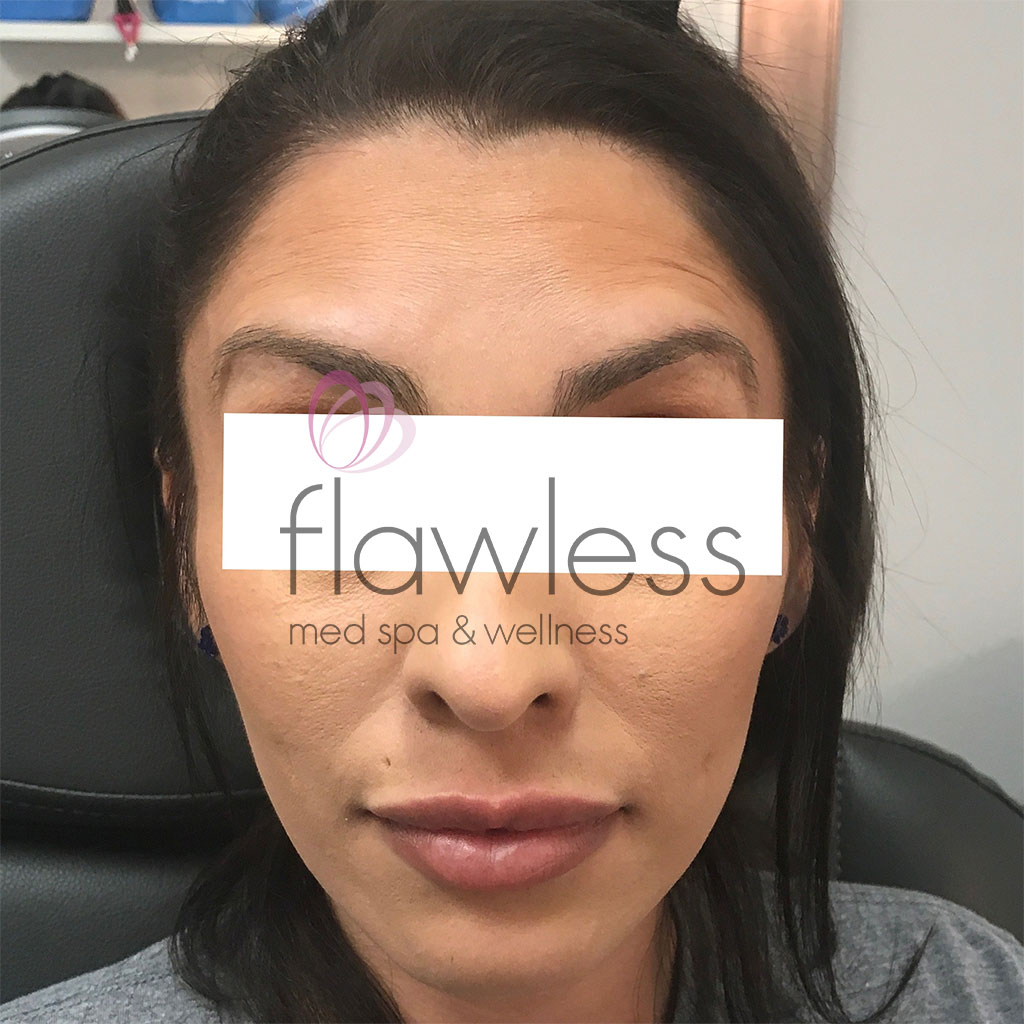 BOTOX Before & After Gallery - Patient 58193344 - Image 4