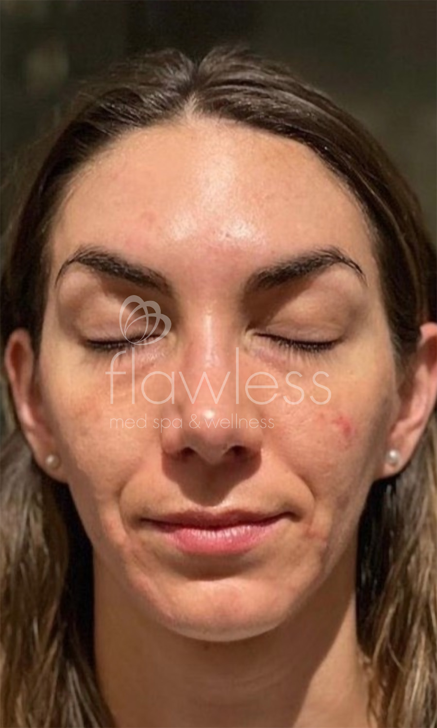 Chemical Peel Before & After Gallery - Patient 58193353 - Image 1