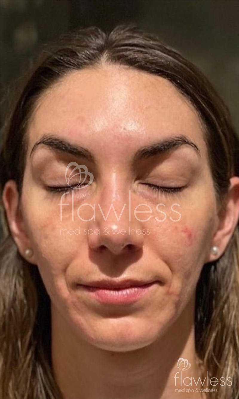 Chemical Peel Before & After Gallery - Patient 58193353 - Image 1