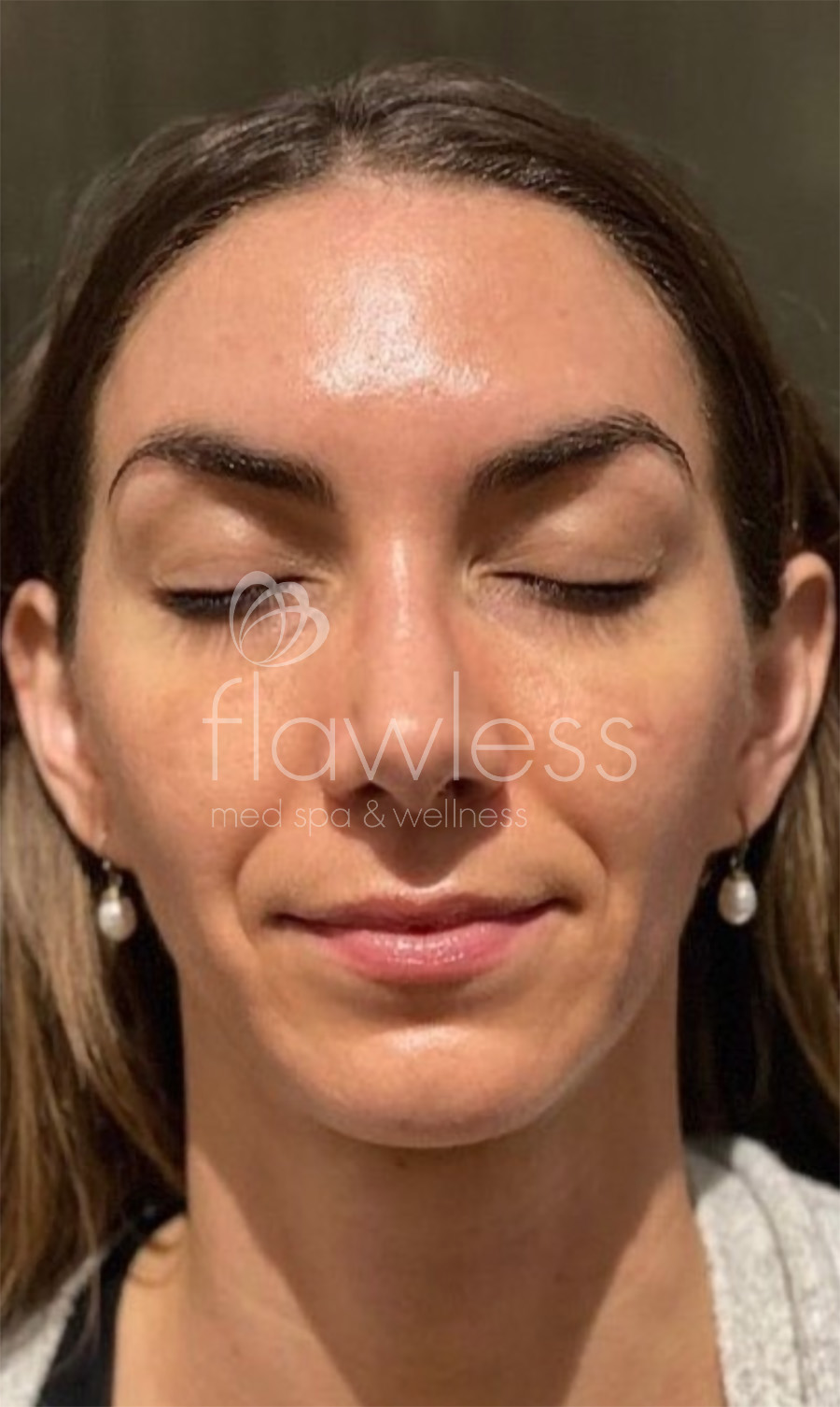 Chemical Peel Before & After Gallery - Patient 58193353 - Image 2