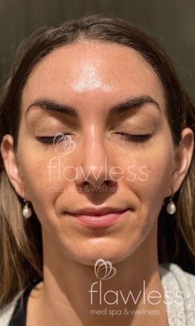 Chemical Peel Before & After Gallery - Patient 58193353 - Image 2