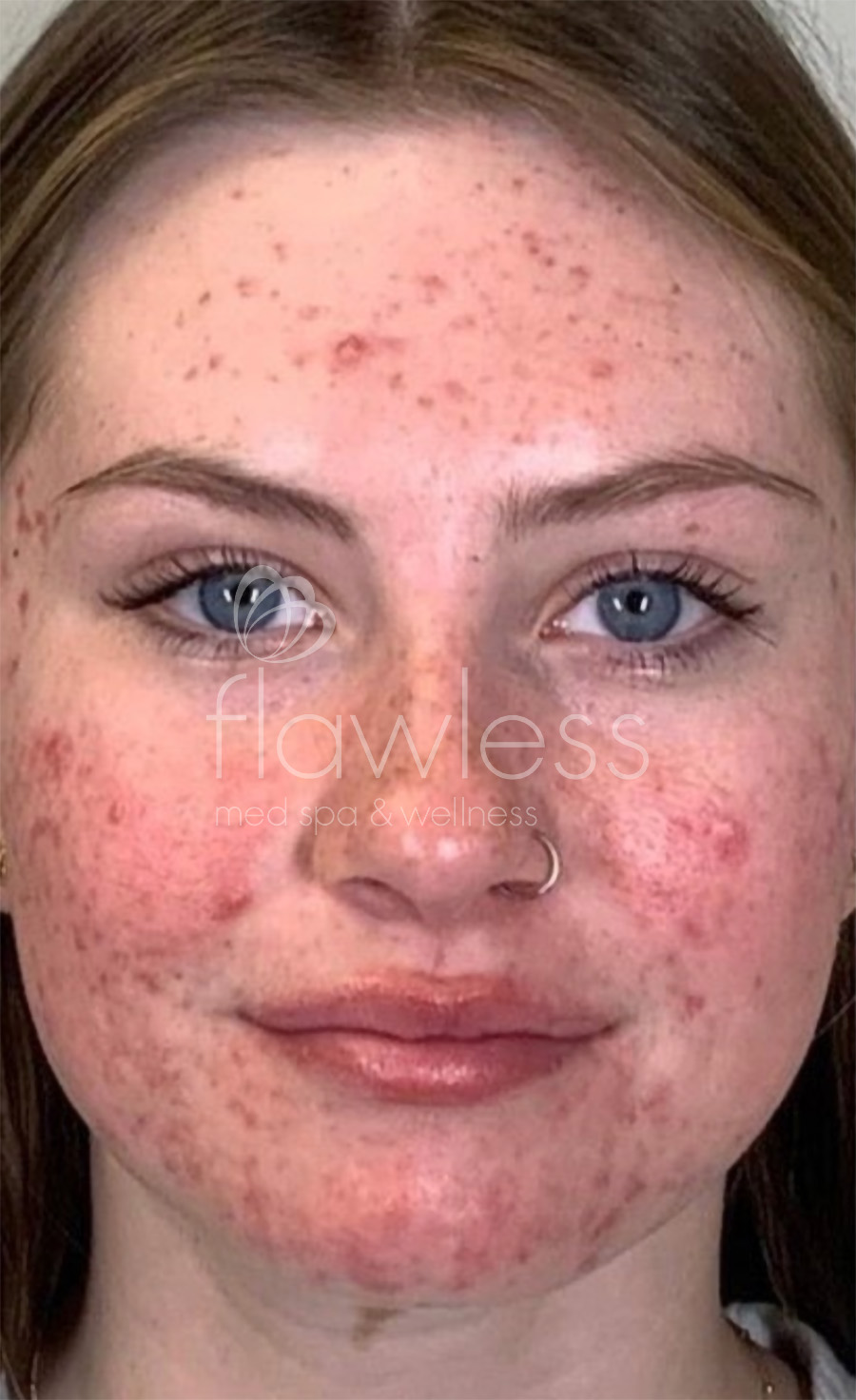 Chemical Peel Before & After Gallery - Patient 58193355 - Image 1