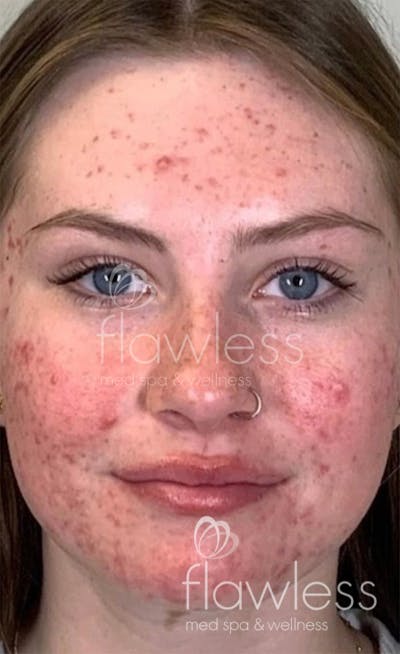 Chemical Peel Before & After Gallery - Patient 58193355 - Image 1
