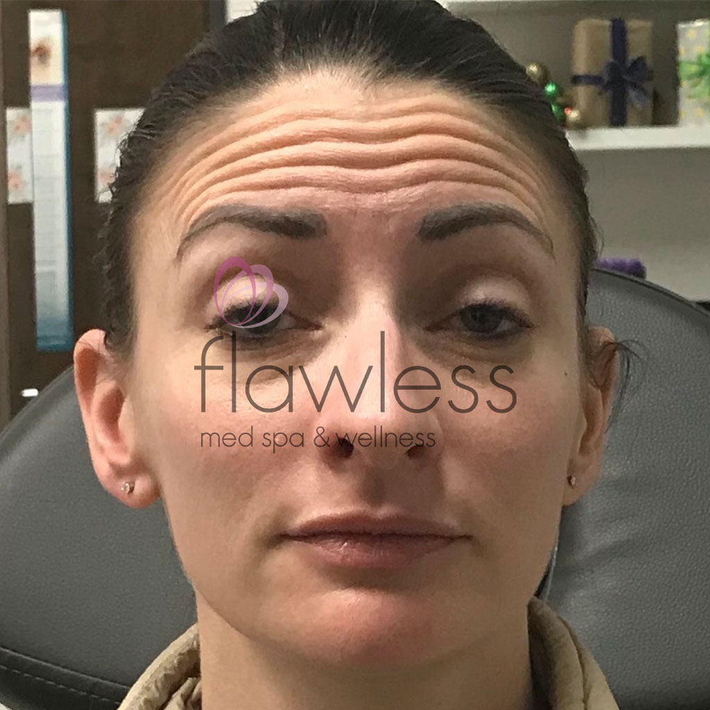 BOTOX Before & After Gallery - Patient 58193356 - Image 1