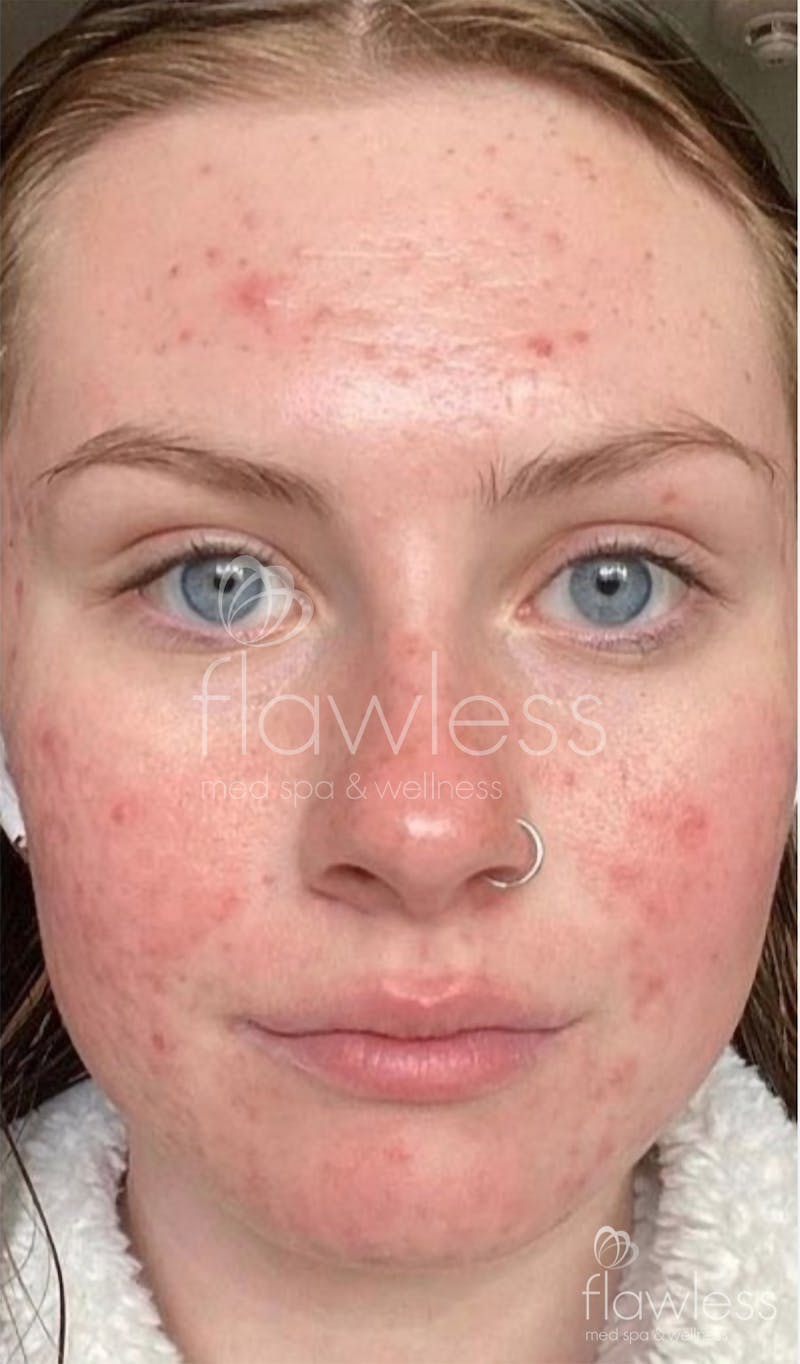Chemical Peel Before & After Gallery - Patient 58193355 - Image 2