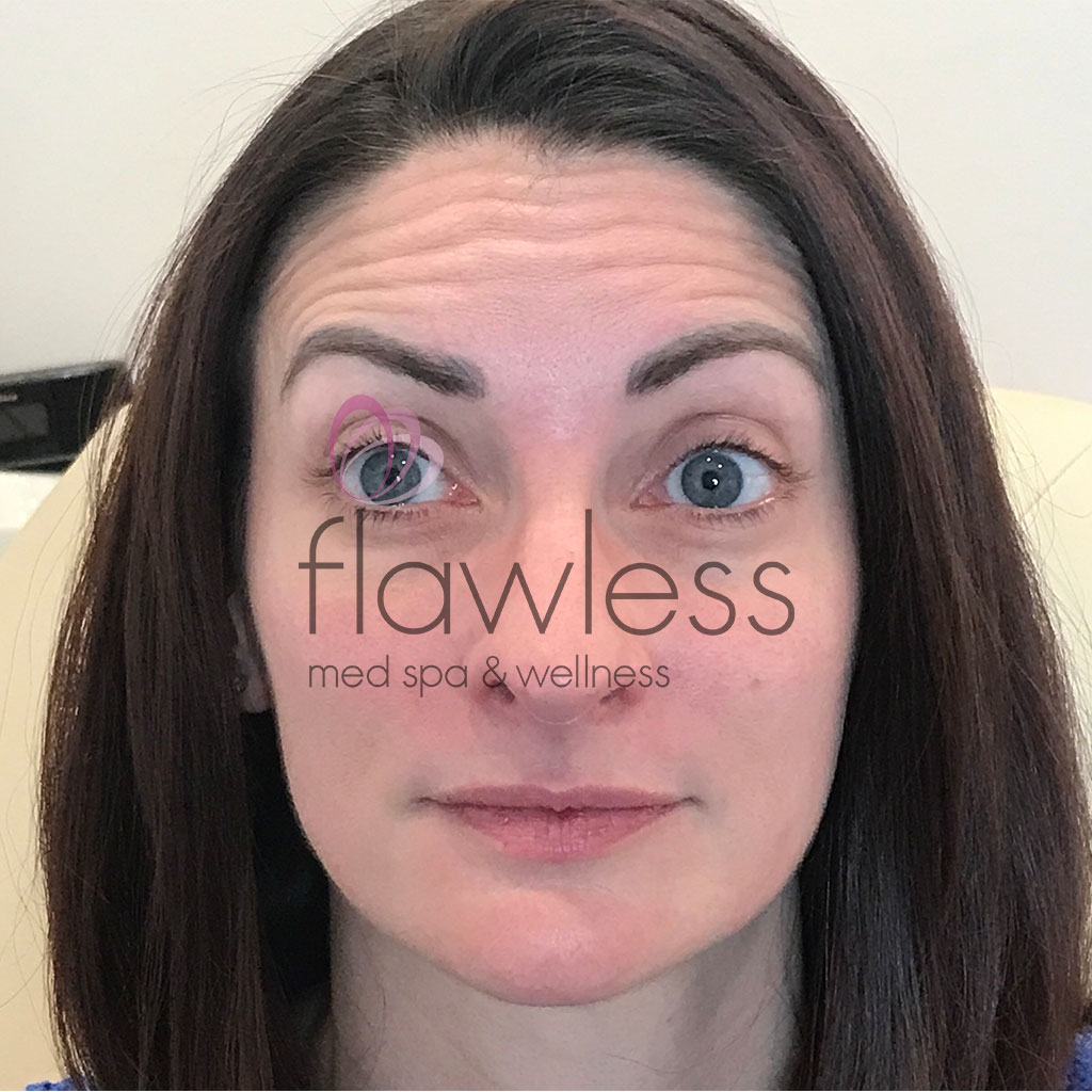 BOTOX Before & After Gallery - Patient 58193356 - Image 2