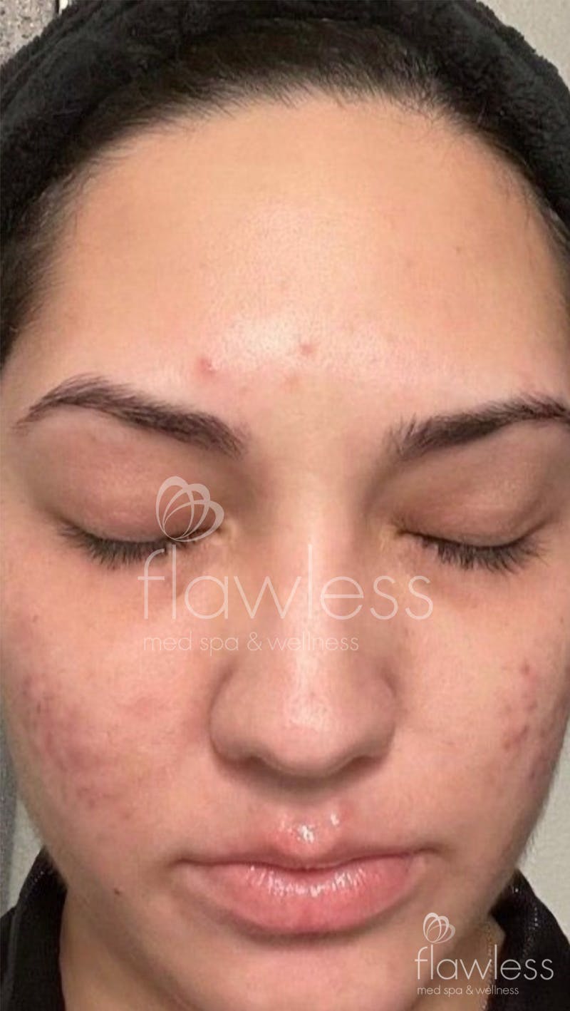 Chemical Peel Before & After Gallery - Patient 58193358 - Image 1