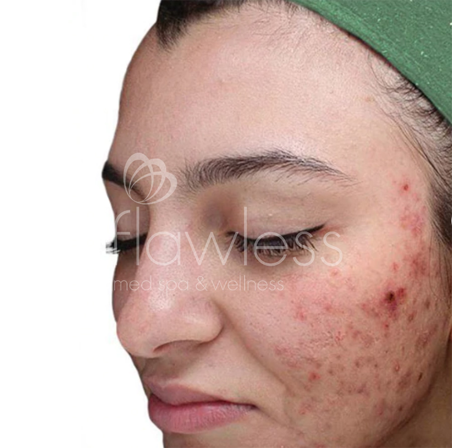 Chemical Peel Before & After Gallery - Patient 58193361 - Image 1