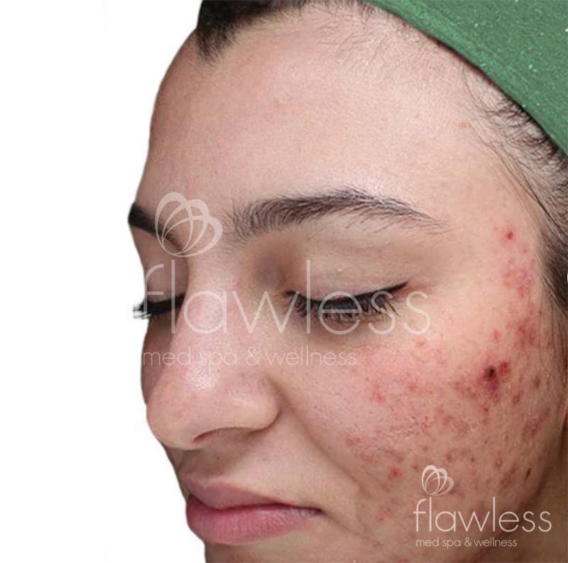 Chemical Peel Before & After Gallery - Patient 58193361 - Image 1