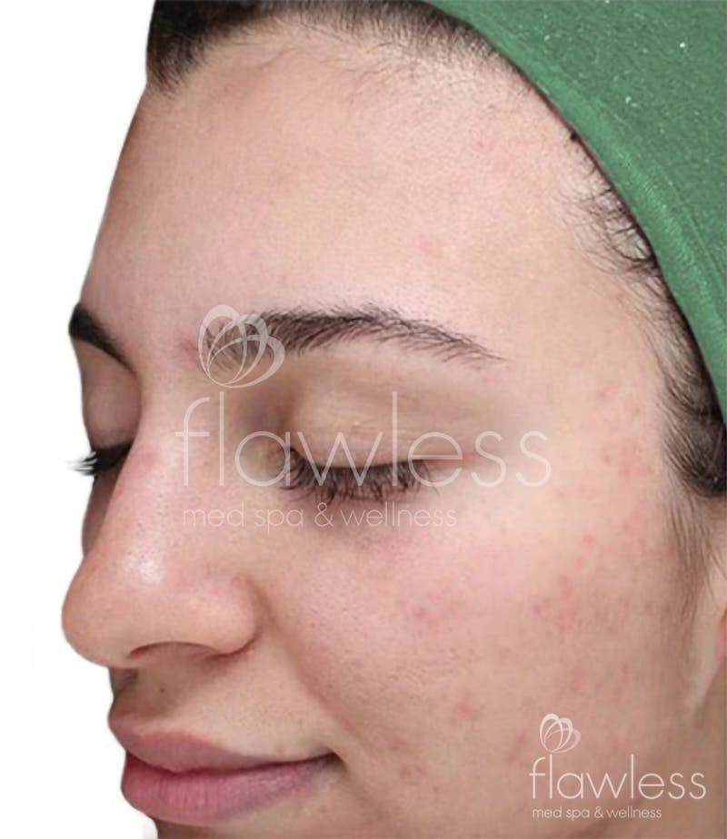 Chemical Peel Before & After Gallery - Patient 58193361 - Image 2