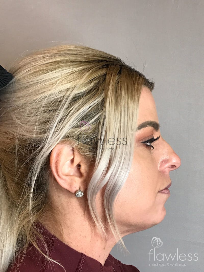 Jawline & Chin Filler Before & After Gallery - Patient 58193366 - Image 1