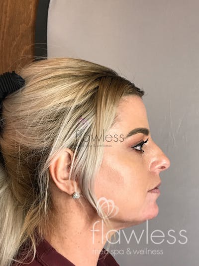 Jawline & Chin Filler Before & After Gallery - Patient 58193366 - Image 2
