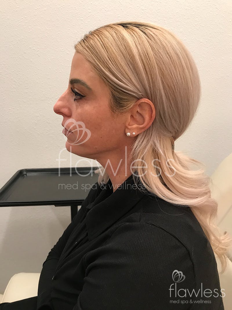 Jawline & Chin Filler Before & After Gallery - Patient 58193368 - Image 1