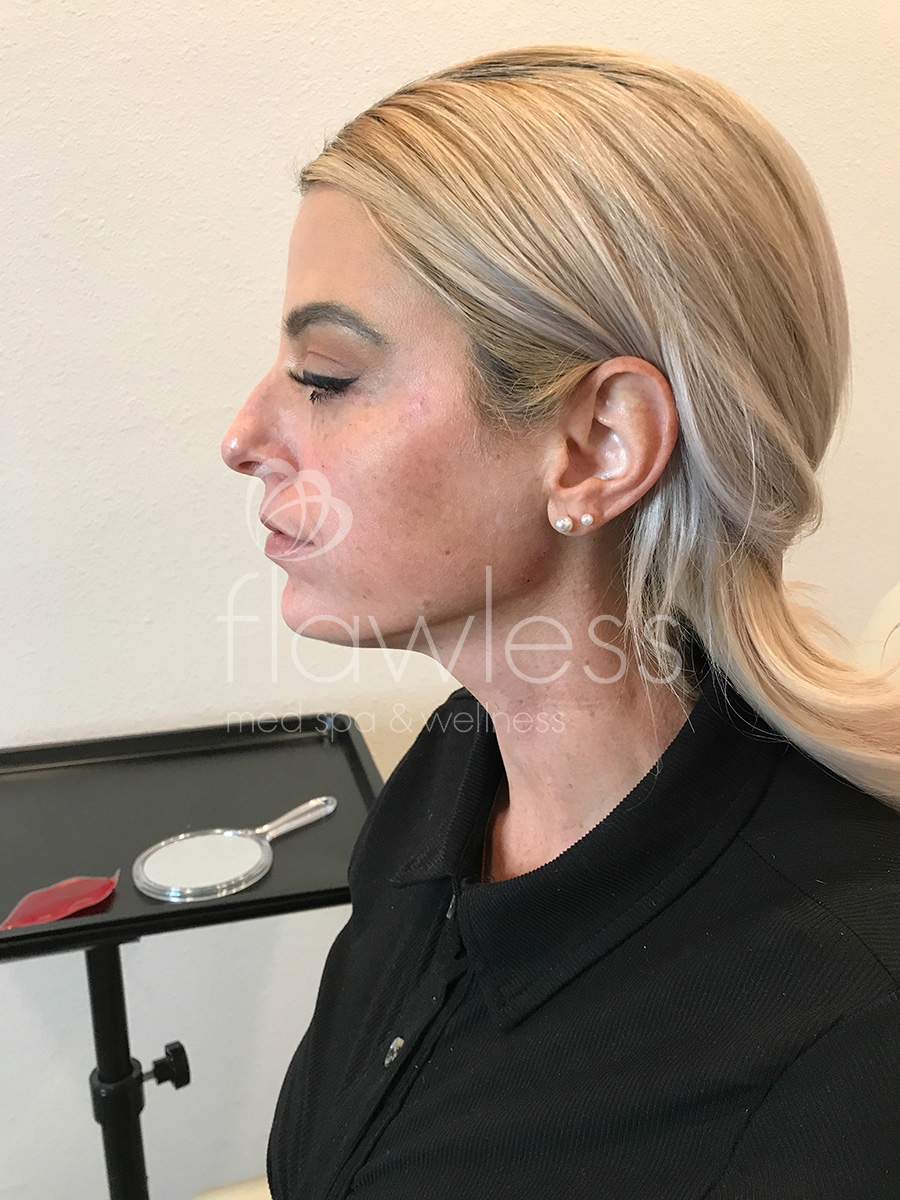 Jawline & Chin Filler Before & After Gallery - Patient 58193368 - Image 2