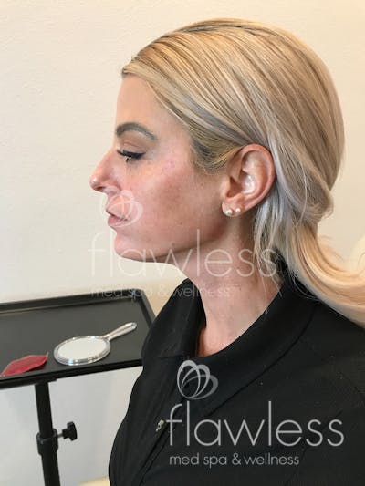 Jawline & Chin Filler Before & After Gallery - Patient 58193368 - Image 2