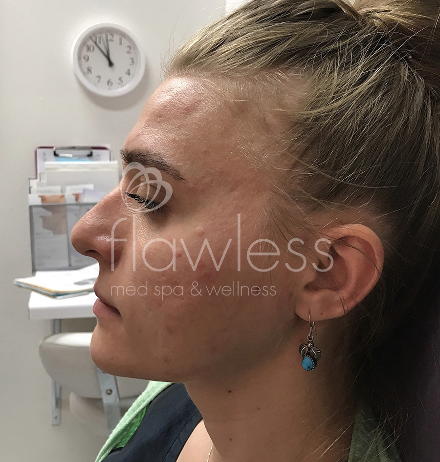 Jawline & Chin Filler Before & After Gallery - Patient 58193370 - Image 1