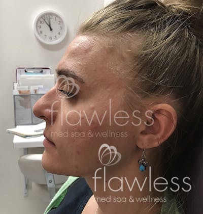 Jawline & Chin Filler Before & After Gallery - Patient 58193370 - Image 1