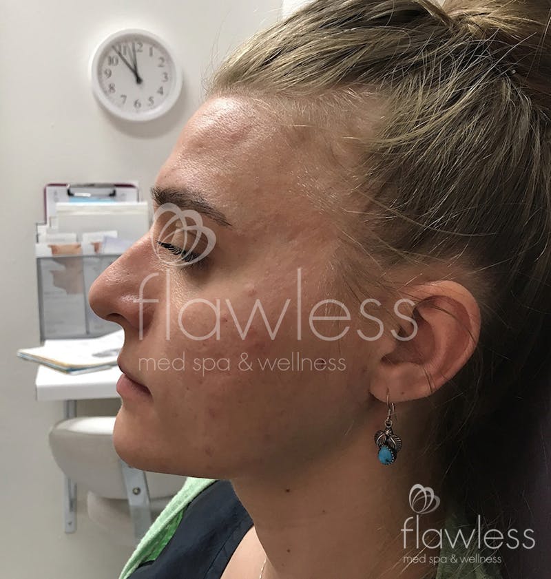 Jawline & Chin Filler Before & After Gallery - Patient 58193370 - Image 1